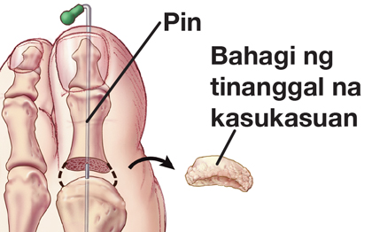 Kasukasuang inalis at mga turnilyo na ikinabit sa hinlalaki ng paa