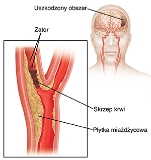 Skrzep krwi blokujący tętnicę szyjną i zator rozrywający skrzep. Zbliżenie pokazuje uszkodzenie mózgu.