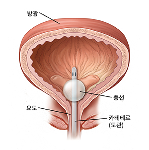 카테테르가 삽입된 방광의 단면 모습.