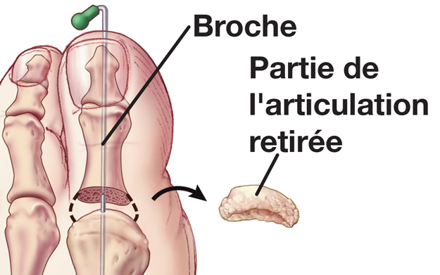 L'articulation du gros orteil montrant la partie de l'articulation retirée et une broche de raccordement des os