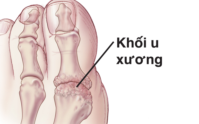 Tăng trưởng xương trong ngón chân cái