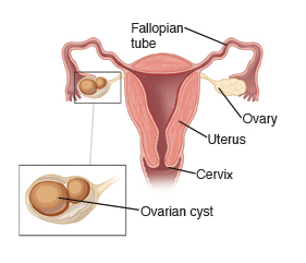 Image showing a cross-section of the uterus, with Fallopian tubes, cervix, ovaries, and an ovarian cyst.