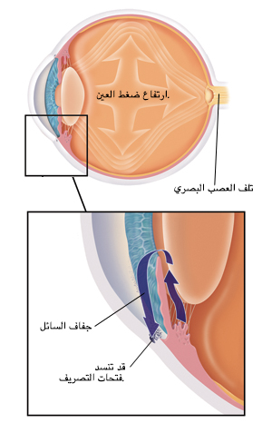 مقطع عرضي للعين يُظهر ارتفاع ضغط العين. صورة مقرّبة تُظهر فتحات تصريف مسدودة.