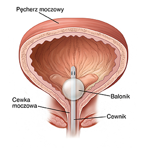 Przekrój pęcherza z włożonym cewnikiem.