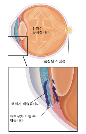 안의 화살표가 압력이 커지고 있는 상태를 보여주고 있는 눈의 측면도. 눈 뒤쪽의 시신경이 손상되었습니다. 망막이 수정체를 덮고 있는 눈 단면도 클로즈업 모습. 동공은 홍채 중앙에서 열립니다. 수정체는 홍채 뒤에 있습니다. 액체는 홍채 뒤쪽에서 동공을 통해 홍채 앞쪽으로 빠져나옵니다. 그런 다음 망막 부근의 구멍(배액구)을 통해 눈 밖으로 빠져나갑니다. 배액구가 막힐 수 있습니다.