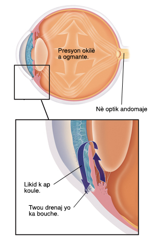 Yon imaj lateral ak flèch anndan l kap moutre presyon ki ap moute. Nè optik la ki dèyè je a andomaje. Yon gwo plan nan je a kote kòne a kouvri iris la. Pipiy la ouvri nan mitan iris la. Lantiy la dèyè iris la. Likid la sòti dèyè iris la soti nan pipiy la pou l ale devan iris la. Aprè sa likid la koule soti deyò nan je a nan twou yo ki pre kòne a. Twou ki pou drene likid la ka vin bloke.