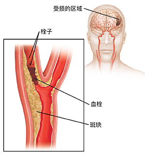阻塞颈动脉的血栓和脱落凝块的栓子。插图显示大脑受损。