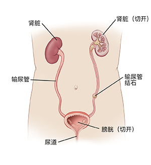 图示显示泌尿系统的解剖结构，包括肾脏、膀胱、尿道和输尿管中的结石。