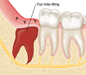 Cận cảnh mặt cắt xương hàm và răng hàm cho thấy cục máu đông ở nơi nhổ răng khôn.