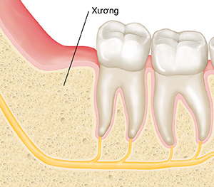 Cận cảnh mặt cắt ngang của xương hàm và răng hàm cho thấy xương nơi răng khôn đã được nhổ.