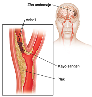 Kayo sangen ki bloke atè kawotid la epi anboli a kase kayo a. Yon fèy ki ap moutre domaj ki gen nan yon sèvo.