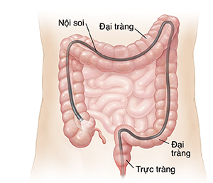 Đường viền bụng cho thấy ống soi được đưa qua hậu môn vào toàn bộ đại tràng.