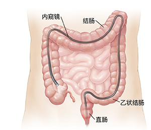 显示内窥镜经肛门插入整个结肠的腹部的轮廓。